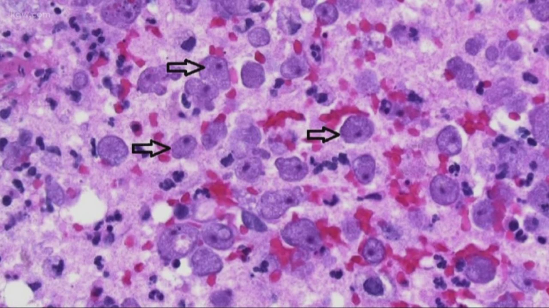 VERIFY Can using tap water in a neti pot lead to a deadly infection?