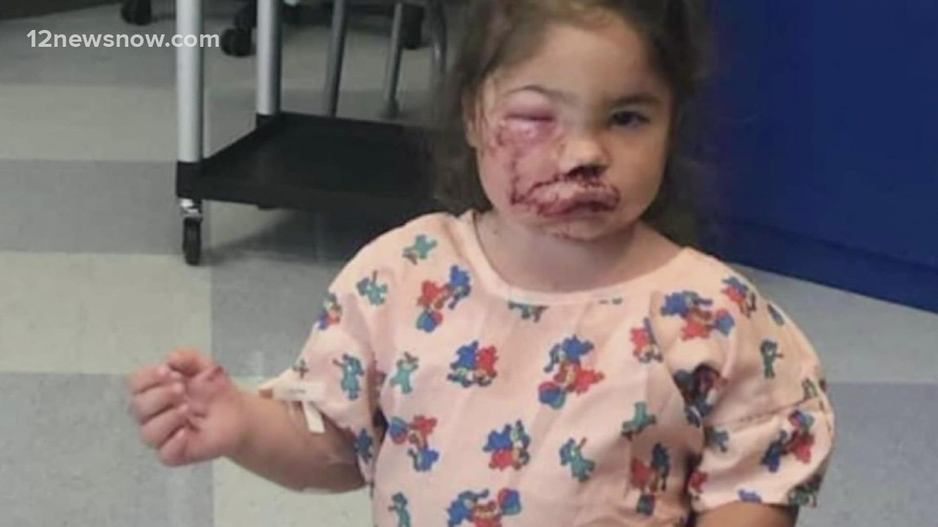 The girl was bitten by the dog in the face on Mother's Day.