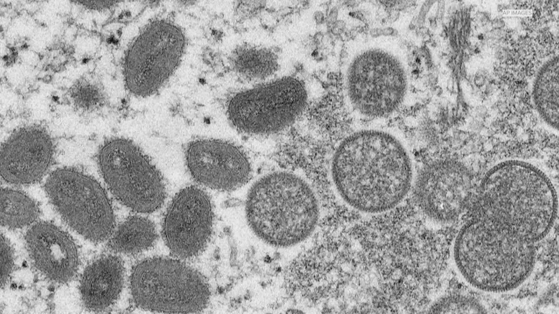 76 cases of monkeypox confirmed in Texas, officials say