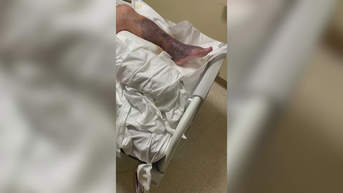 Doctors working to develop vaccine for flesh-eating bacteria that forced Bridge City man to amputate leg